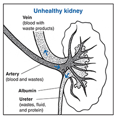 Drawing of a kidney cross section that shows an  unhealthy kidney with the vein, artery, ureter, and albumin labeled and their functions described 